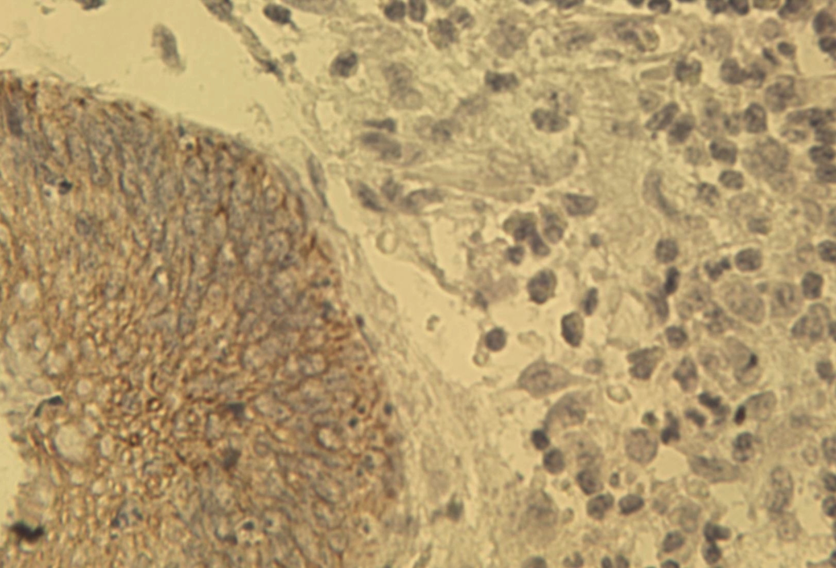 Figure 1. Immunohistochemical staining of human colon cancer tissue using pan Keratin antibody (Cat. No. X1260M) at 2.5 μg/ml.